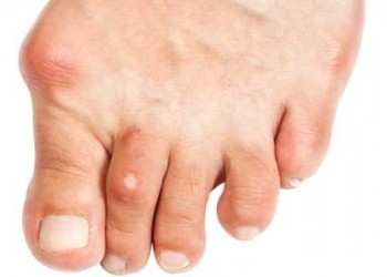 boli ale articulațiilor pe degetele de la picioare