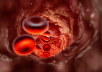 anemie hemolitica microangiopatica miros de condilom