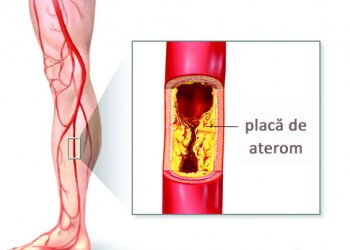 arteriopatie obliterantă