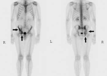 cancer de prostata cu metastaze osoase forum)