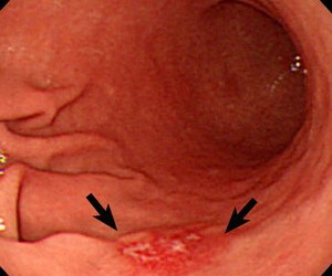 cancerul gastric