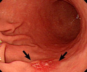 cancer gastric fara simptome