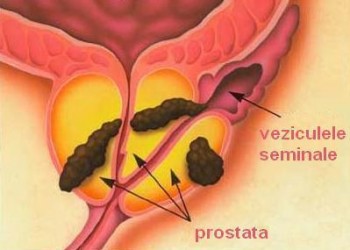 pret operatie prostata robot da vinci