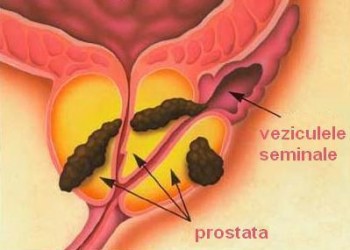 Cancer de prostată – Cauze. Simptome. Tratament