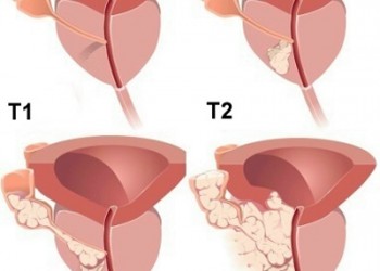 Cum se tratează adenomul de prostată în stadiul 2