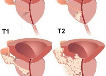 cancer prostatic tratament