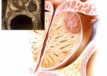 Noutati tratament cancer prostata