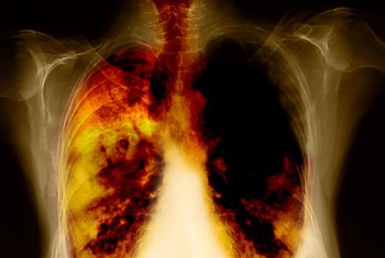 invazia bolilor pulmonare