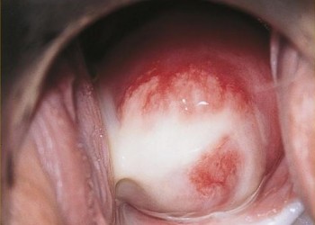 Negii cervicale ectopia, Papilomul cervical. Metode de tratament și vaccinare