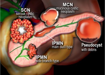 tratamentul prostatitei și adenomului pancreatic)