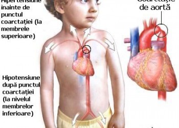 Senate Analytical system Coarctaţia de aortă | Cardiologie | Ghid de boli
