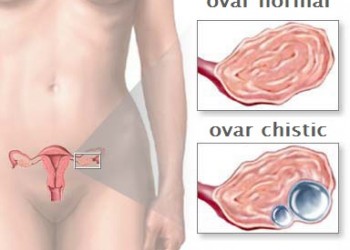 poate pierderea în greutate caută chisturi ovariene