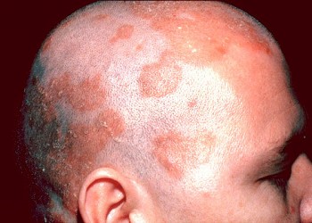 Mai multe informații despre psoriazis și dermatita seboreică