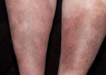 eczema cu simptome varicoase ce poate ajuta de la varicoză