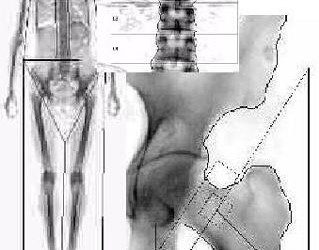 Osteoporoză la șold Tratament de gradul I
