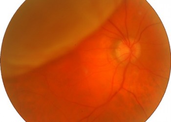 aparat miop de detasare a retinei)