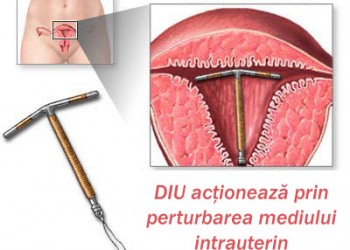 bang tennis Patronise Dispozitivul intrauterin (Steriletul) | Health tips | Lifestyle si sfaturi