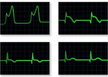 erecția infarctului miocardic