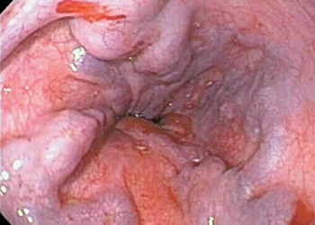 Varicele esofagiene