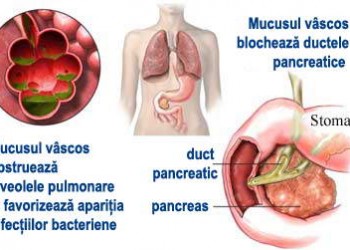 pierderea în greutate din cauza fibrozei chistice)