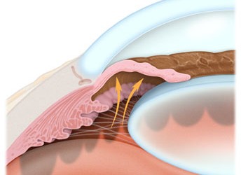 oftalmologie atac acut de glaucom plus viziune ce înseamnă