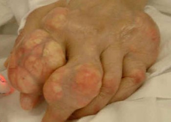 mâini cu artrita guta