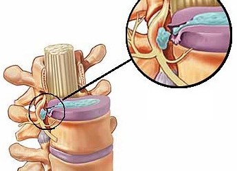 tratament comun pentru medicamente dureri de abducție a articulației șoldului
