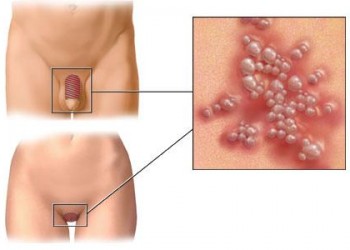 Herpes genital: cauze, tratament și prevenire