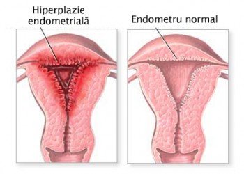 hiperplazie a vederii