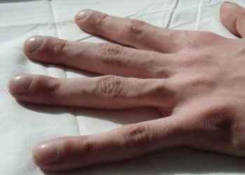 boala articulației degetelor mici)
