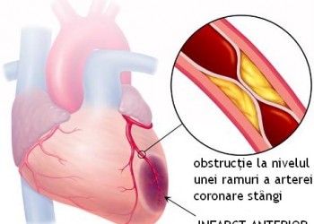 infarct miocardic)