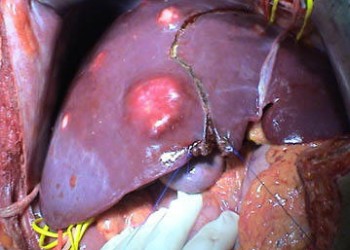 cancer hepatic metastaza)