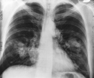 Cancerul pulmonar: Simptome, cauze, tratament, prognostic | dieta-daneza.ro