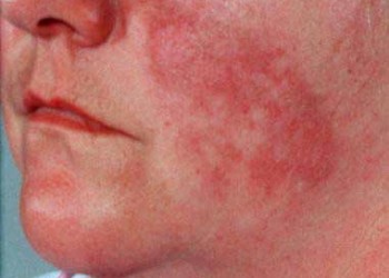 Lupus eritematos sistemic: cauze, simptome si tratament