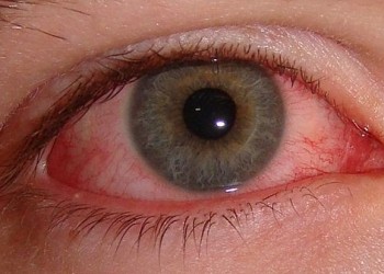 iritatie ochi