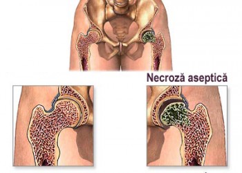 tratament pt steatoza hepatica ucide în mod natural paraziții creierului