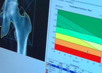 Osteoporoza, boala oaselor fragile