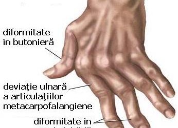 artrita reumatoida stadiul 1