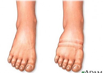 tratamentul de pe pereții varicoși pe picioarele picioarelor varicose science
