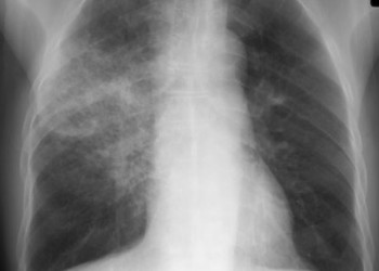Pneumonia: simptome, cauze si tratament | Medlife