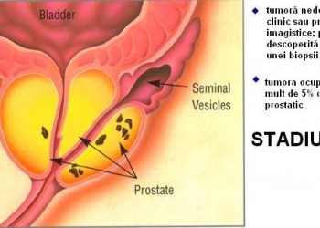 Diagnosticarea cancerului de prostată