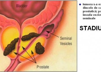 tratament cancer prostata stadiul 4)