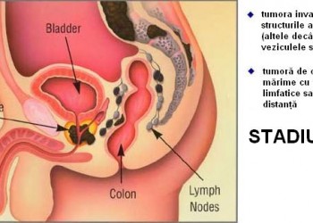 metastaze prostata prostata adenoma mediano