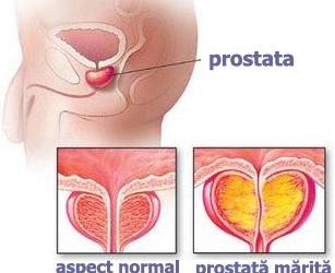 adenom de prostată, prostatita)