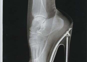 dureri articulare la nivelul piciorului și tocurilor)