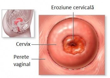 eroziunea condilomului colului uterin)