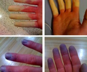 pierdere în greutate raynaud mgtow pierdere în greutate