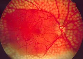 Restaurarea vederii după retinopatie