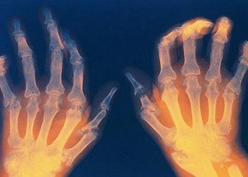 revărsare articulară cu artrită