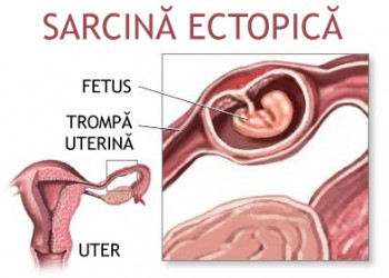 frame hard person Sarcina extrauterina (ectopică) | Ginecologie | Ghid de boli